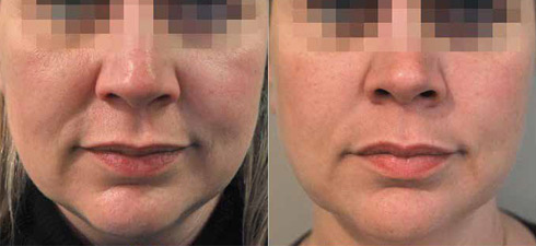 Behandlung mit Profhilo&reg; vorher - nachher